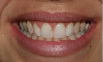 Closeup of teeth and gums after surgery