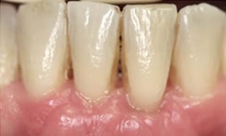 Closeup of teeth and gums after surgery