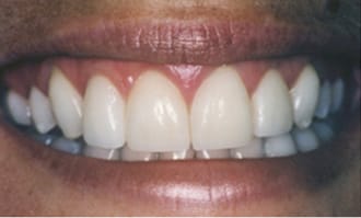 Closeup of teeth and gums after surgery