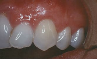 Closeup of teeth and gums after surgery