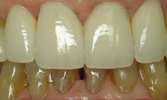 Closeup of teeth and gums after surgery