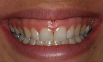 Closeup of teeth and gums before surgery