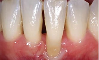 Closeup of teeth and gums before surgery
