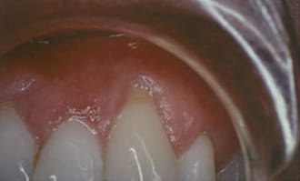 Closeup of teeth and gums before surgery