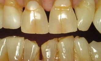 Closeup of teeth and gums before surgery