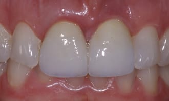 Front teeth implants that look good