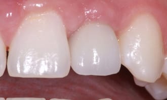 Single tooth replaced