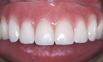 Closeup of full set of teeth after surgery