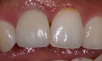 Closeup of front teeth after surgery
