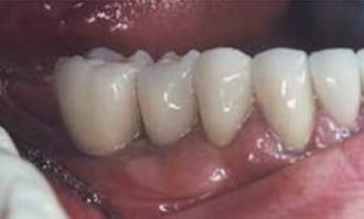 Closeup of teeth and gums after surgery