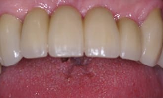Closeup of teeth and gums after surgery