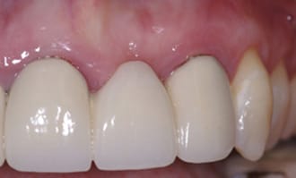 Closeup of teeth and gums after surgery