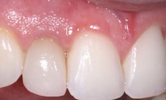 Closeup of teeth and gums after surgery