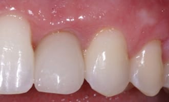 Closeup of teeth and gums after surgery