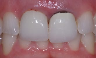 Front teeth implants that need to be redone