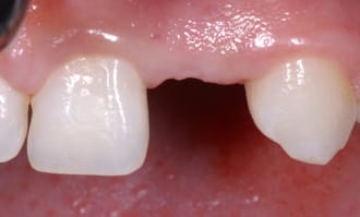 Missing tooth