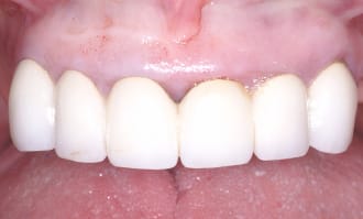 Closeup of full set of implant teeth before surgery