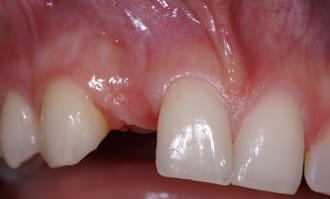 Closeup of teeth and gums before surgery