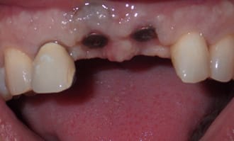 No front teeth only implant abutments