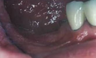 Closeup of teeth and gums before surgery
