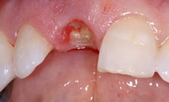 Closeup of teeth and gums before surgery