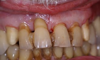 Closeup of teeth and gums before surgery