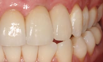 Closeup of teeth and gums before surgery