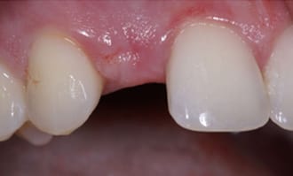 Closeup of teeth and gums before surgery