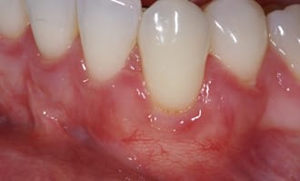 Closeup of teeth and gums after surgery