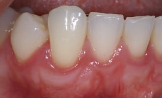 Closeup of teeth and gums after surgery