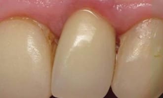 Closeup of teeth and gums after surgery