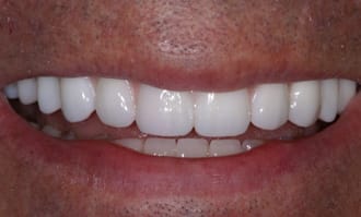 Closeup of teeth and gums after surgery