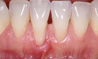 Closeup of teeth and gums before surgery