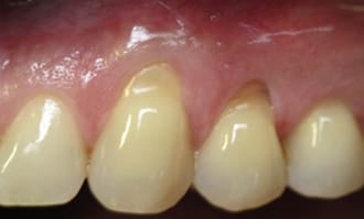 Closeup of teeth and gums before surgery