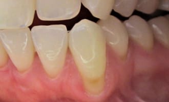 Closeup of teeth and gums before surgery
