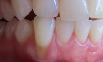 Closeup of teeth and gums before surgery