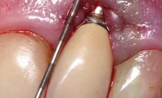 Closeup of teeth and gums before surgery