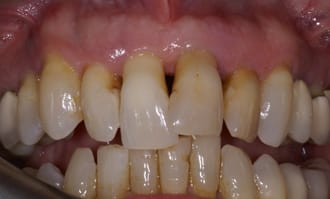 Closeup of teeth and gums before surgery