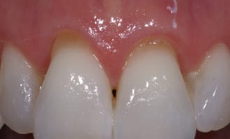 Closeup of front teeth recession before surgery